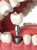 انواع ایمپلنت دندان؛ تفاوت و هزینه‌ی آن‌ها