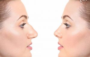 جراحی زیبایی بینی؛ قیمت سال ۹۹ و جدیدترین انواع آن