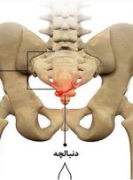 درد استخوان دنبالچه؛ چه علائمی دارد؟