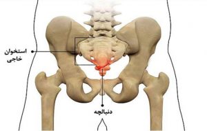 درد استخوان دنبالچه؛ چه علائمی دارد؟