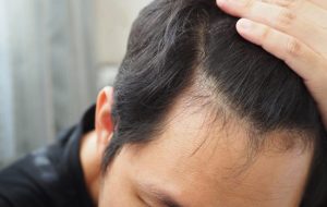 دلایل ریزش مو در مردان؛ هراسِ کچلی