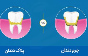 روش‌های سنتی جِرم‌گیریِ دندان در خانه