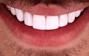 لمینت دندان ارزان و هرآنچه باید بدانید