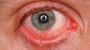 اشک چشم مبتلایان کرونا، آلوده به ویروس است