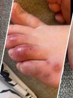 انگشت پای کوویدی؛ عجیب‌ترین علامت ویروس کرونا