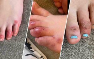 انگشت پای کوویدی؛ عجیب‌ترین علامت ویروس کرونا