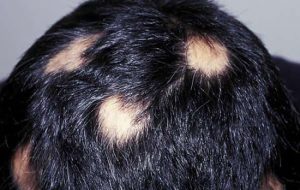 «ریزش موی سکه‌ای» از تشخیص تا درمان