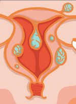 فیبروم در بارداری چقدر خطرناک است؟