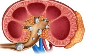 راهکار‌های خانگی برای دفع سنگ کلیه