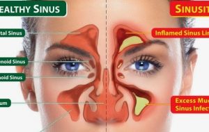 راهکارهایی برای درمان «سینوزیت» – خبرآنلاین