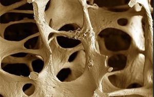 این موارد را رعایت کنید تا پوکی استخوان نگیرید