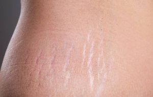 ترکیبی برای محو ترکهای پوستی