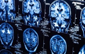 کرونا اثراتی شبیه آلزایمر و پارکینسون روی مغز دارد