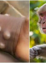 آبله میمونی، بیماری ناشناخته با علائمی خفیف