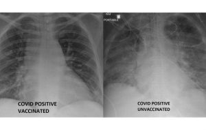 مقایسه تاثیر متفاوت کرونا بر ریه، قبل و بعد از واکسیناسیون