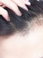 روش‌هایی برای جلوگیری از ریزش موی سر