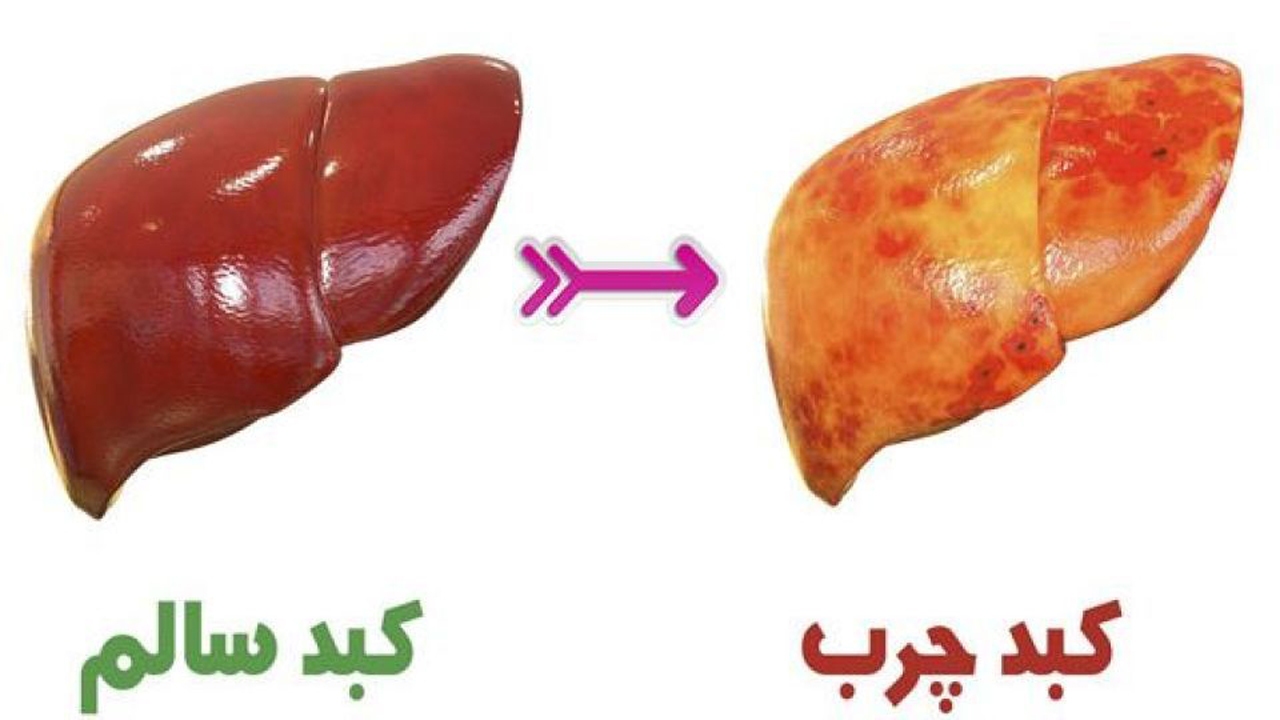 کبد چرب 