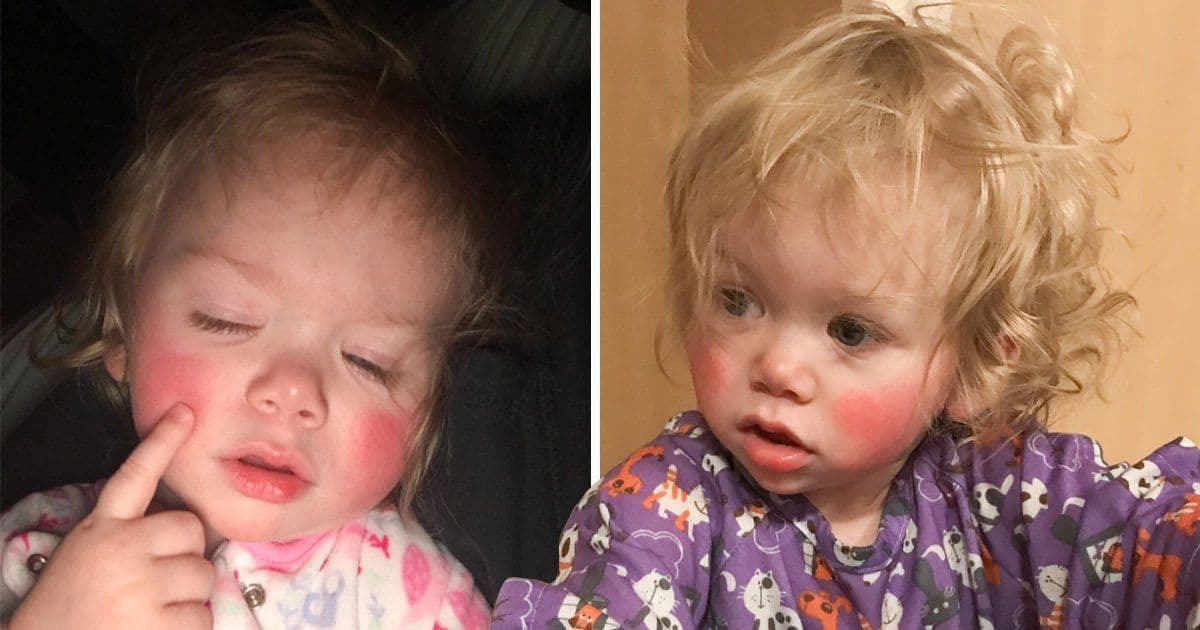 حساسیت به آب