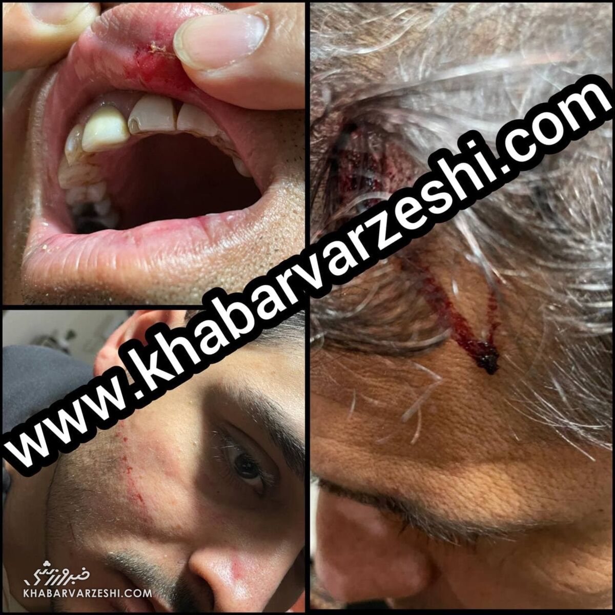 تصاویر دلخراش از ضرب و شتم پیشکسوت پرسپولیس و استقلال/ سر و دندان خودم را شکستند و صورت و سینه پسرم مجروح شد/ خدا رحم کرد کور نشدم
