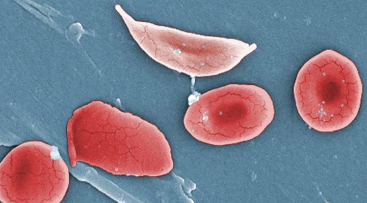 سلول‌های داسی در کم خونی داسی شکل