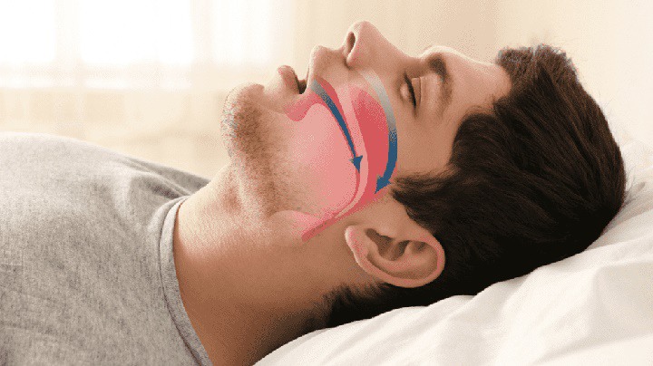 مراحل خواب - آپنه خواب یکی از عوامل اختلال در خواب