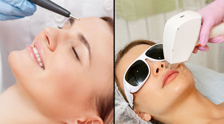 تفاوت الکترولیز موهای زائد و لیزر موها