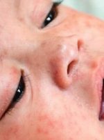علائم “سرخک” و اهمیت واکسیناسیون کودکان در موعد مقرر