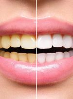 سفیدکننده‌های دندان مجاز یا غیر مجاز؟