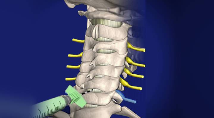 تزریق استروئید به ریشه اعصاب برای درمان اسپوندیلوز