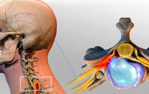 بهترین راه درمان دیسک گردن