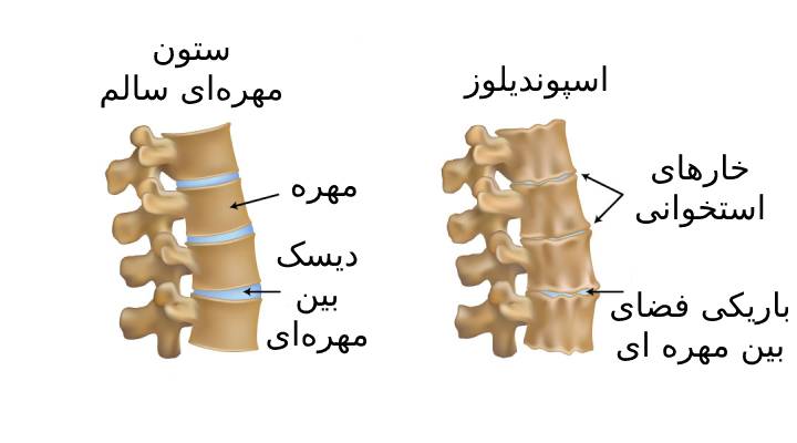 تغییرات آناتومی در بیماری اسپوندیلوزیس