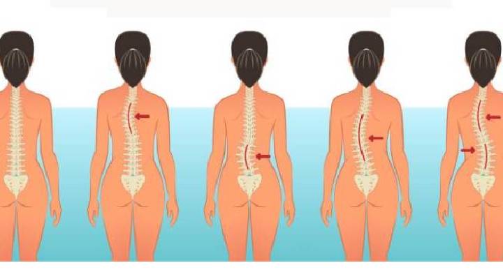 انحنای ستون فقرات در اسکولیوز