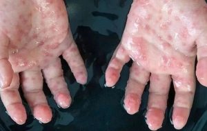 در صورتی که مشکوک به آبله میمون شدیم چکار کنیم؟/ ۵ تا ۲۱ روز دوره کمون این بیماری