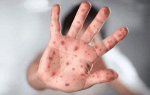 دوره نهفتگی آبله میمون چند روز است؟ دوره نهفتگی آبله میمون چند روز است؟