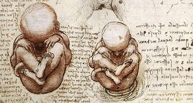 زنی بعد از ۴۵ سال یک نوزاد سنگی به دنیا آورد