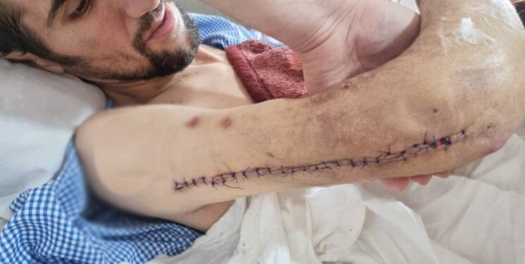 عکس | پیوند موفقیت‌آمیز دست جداشده یک کارگر در یزد