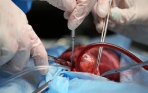 اهدای عضو از فردی با مرگ قلبی شدنی است؟ اهدای عضو از فردی با مرگ قلبی شدنی است؟