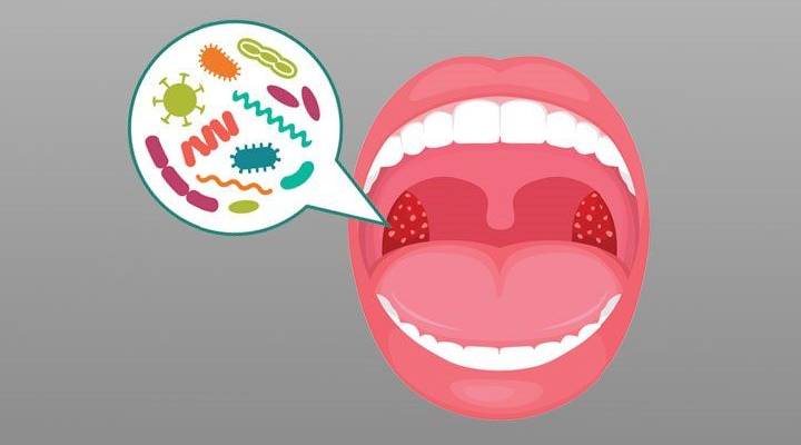 التهاب لوزهها از علل فارنژیت