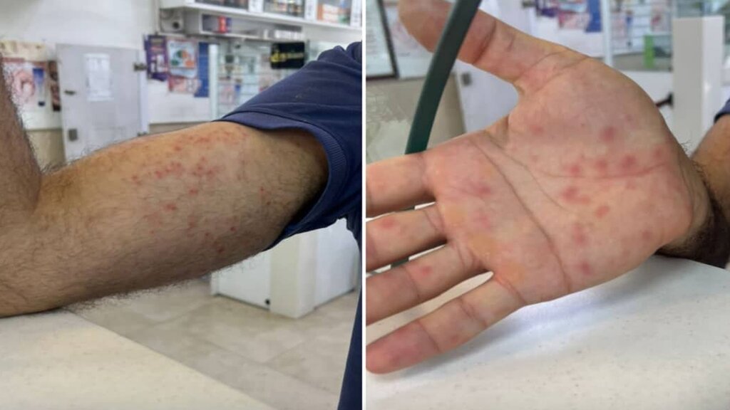 آبله میمون به مازندران رسیده است؟