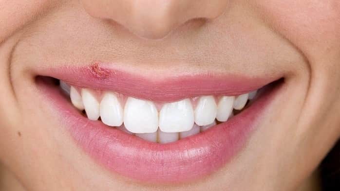 درمان تبخال