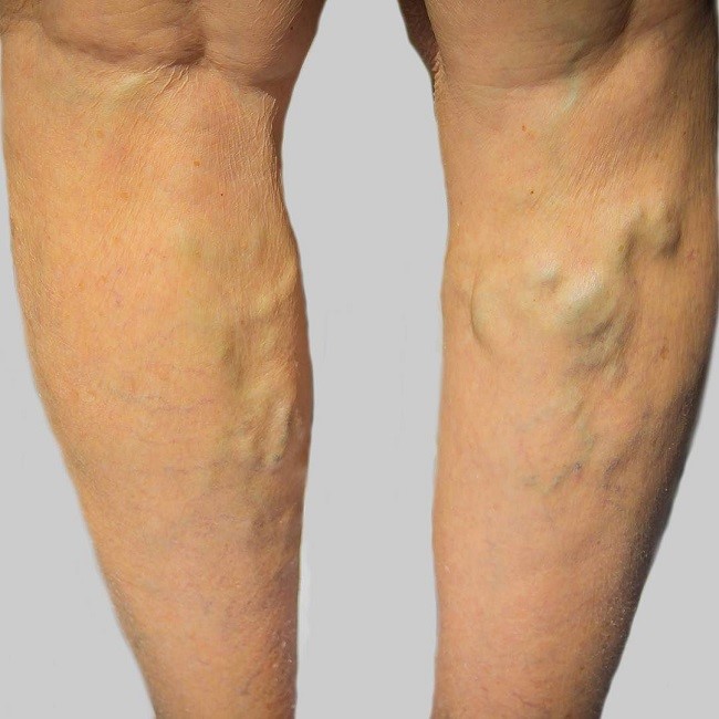 رگ های بیرون زده