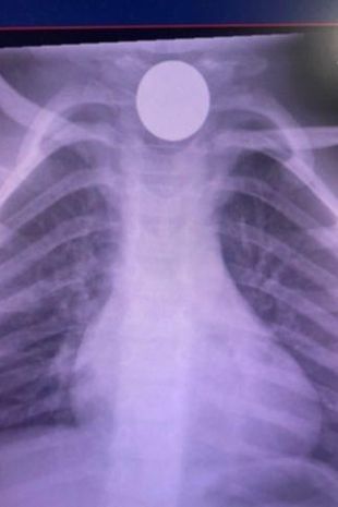 قورت دادن سکه، کودک را به آستانه خفگی برد