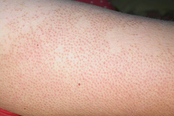 چند ترفند ساده برای خداحافظی با پای توت فرنگی