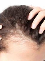 یک درمان جدید برای ریزش مو