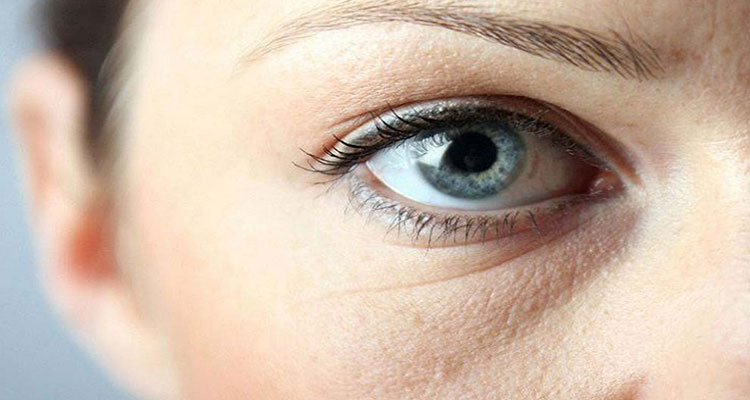 چروک دور چشم