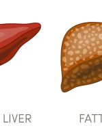 علائم، علل و درمان کبد چرب و ناسالم