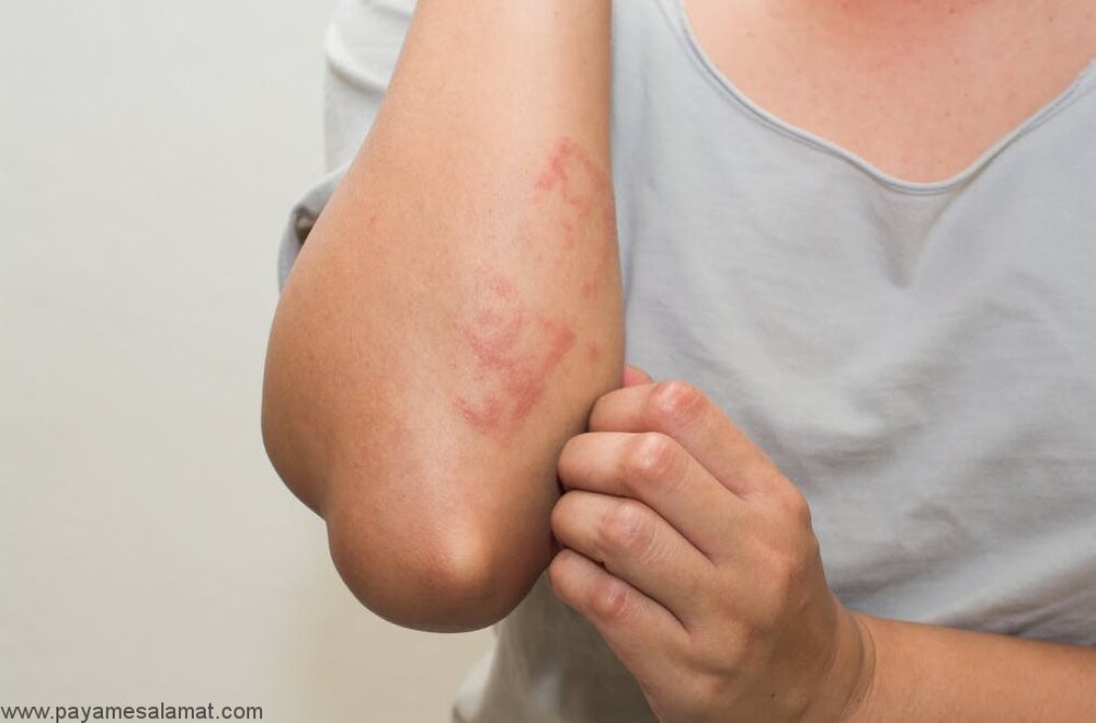 ۷ نشانه‌ افزایش قند خون که روی پوست ظاهر می‌شود