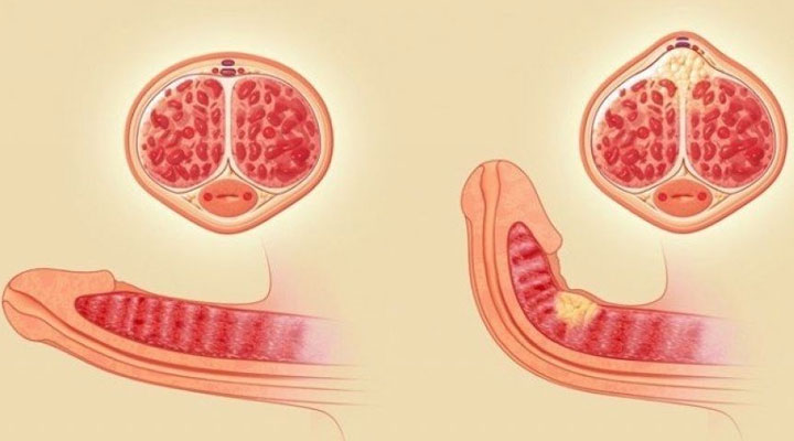 بیماری پیرونی یا کجی آلت تناسلی