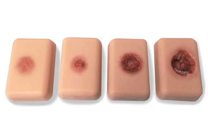 درجات زخم بستر