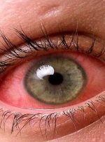 اگر قرمزی چشم دارید، چه زمانی باید به چشم پزشک مراجعه کنید؟